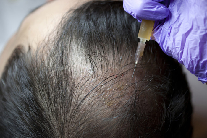 Hair Regrowth Treatment in hyderabad